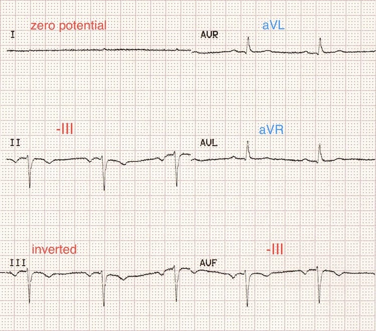 Bilateral arm-leg reversal