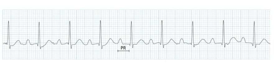 ECG Rhythm strip PR interval prolonged 1st degree AV block