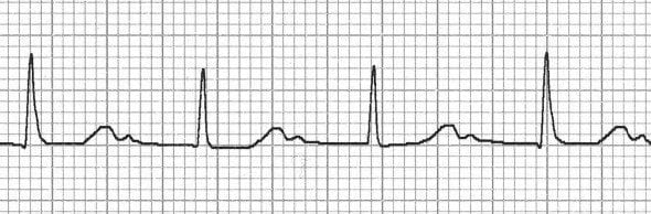 Hidden P waves in marked 1st degree heart block
