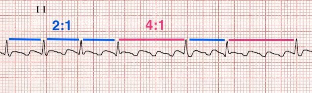 ECG Atrial flutter variable block rhythm strip