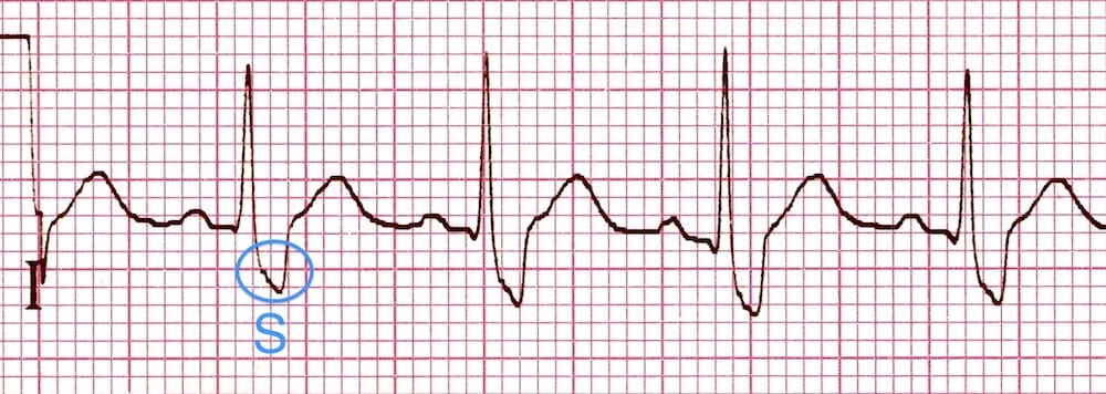 ECG Right Bundle Branch Block RBBB Lead I wide S