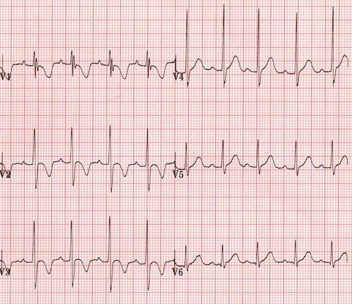 Paediatric T waves Normal T waves 2 year old boy