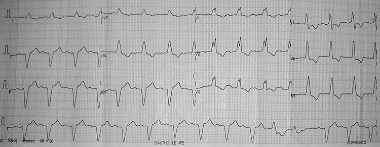 Masquerading Bundle Branch Block (MBBB) 2020