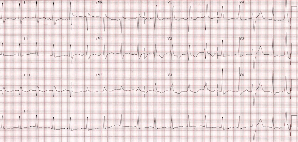 Acute massive PE with s! Q3 T3 RBBB TWI V1-3