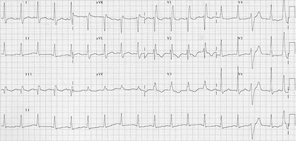 ECG pulmonary embolus