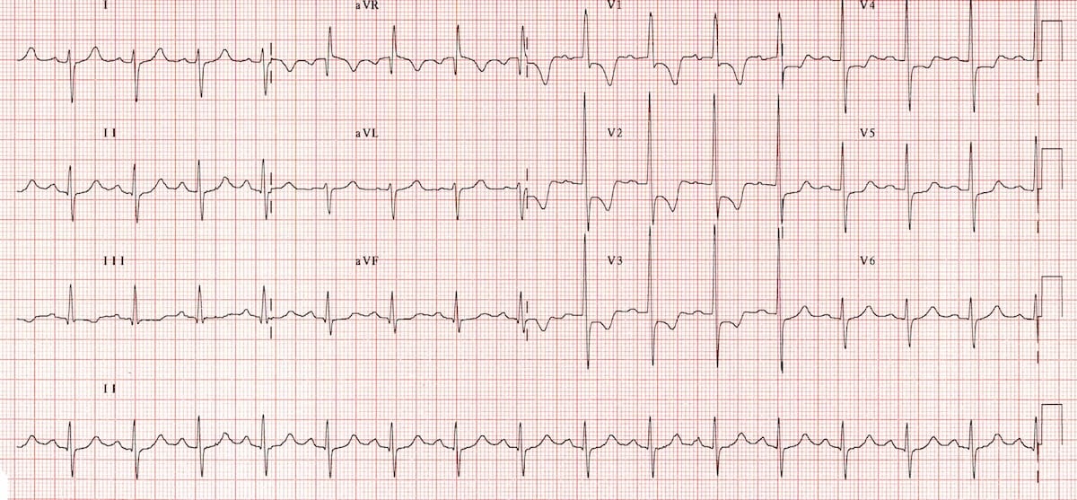 ECGH RVH Right ventricular hypertropy RV Strain