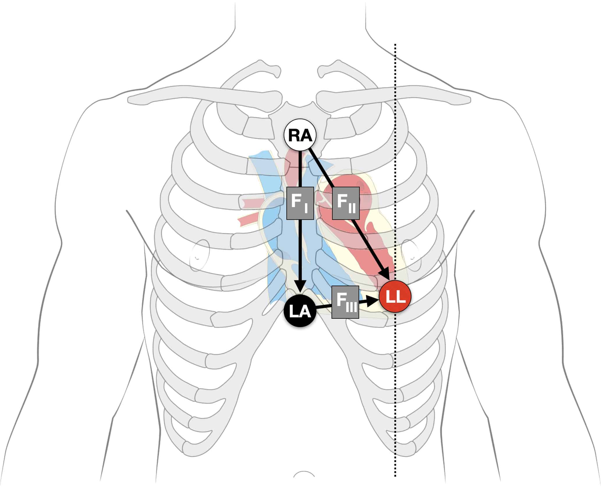 Fontaine lead placement FI F II F III with heart and vectors