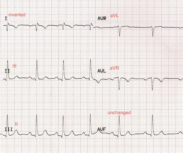 ECG Leads LA RA Reversal
