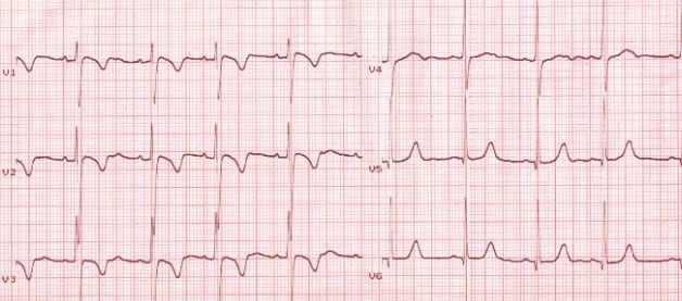 Juvenile-T-wave-inversion Persistent Juvenile T-wave Pattern