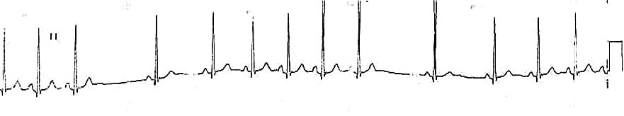 ECG SA Block type 1