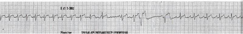 ECG Rhythm strip Exigency 003 5