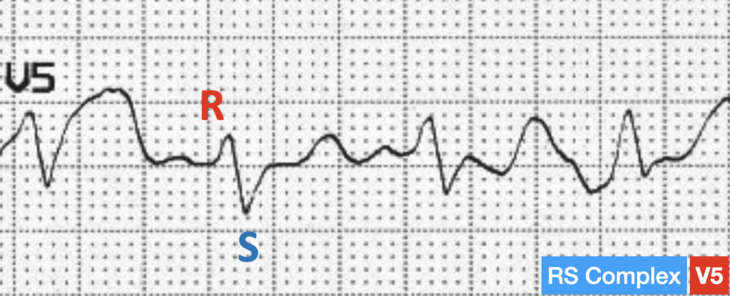 LBBB QRS morphology RS complex
