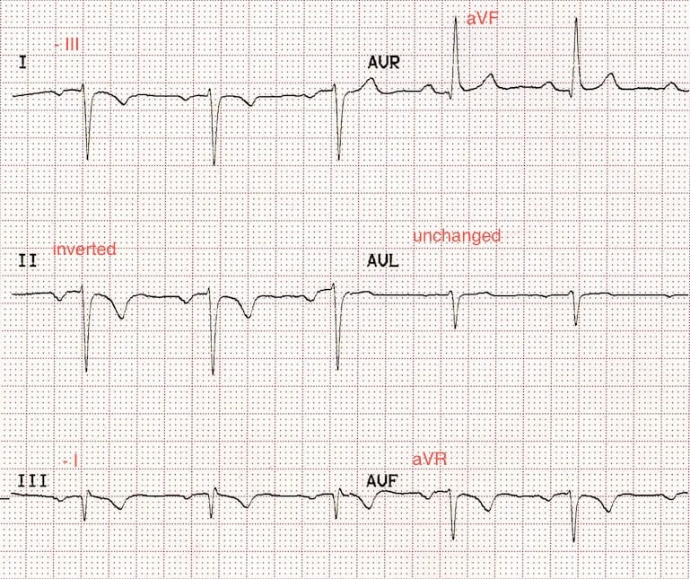 ECG Leads RA LL Reversal