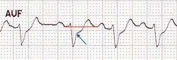 ST depression in aVF relative to the T-P baseline