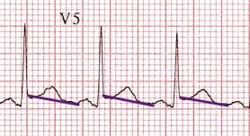 Spodick sign pericarditis
