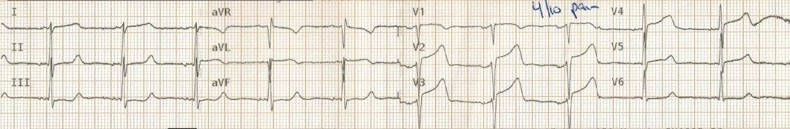 TOP 100 ECG QUIZ LITFL 005 3