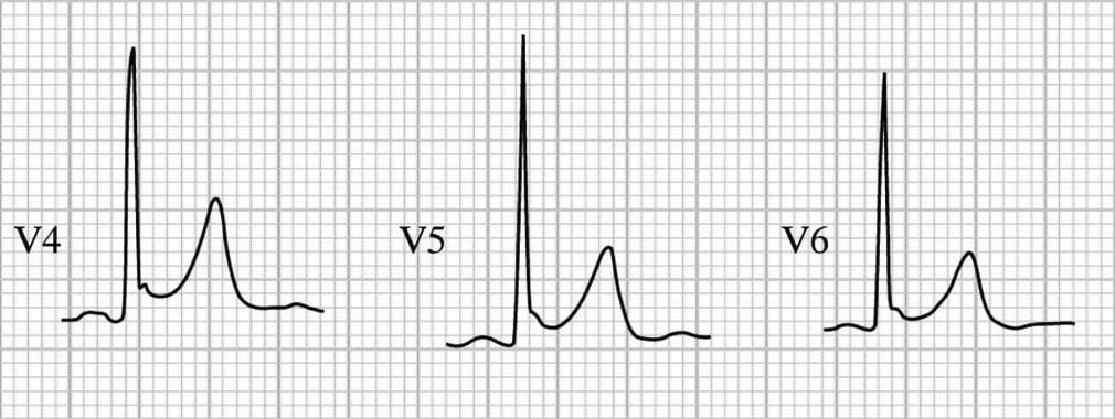 J-point-notching-BER2-1