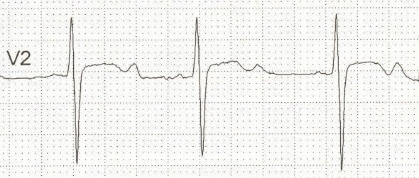 U waves associated with hypokalaemia potassium 1.9