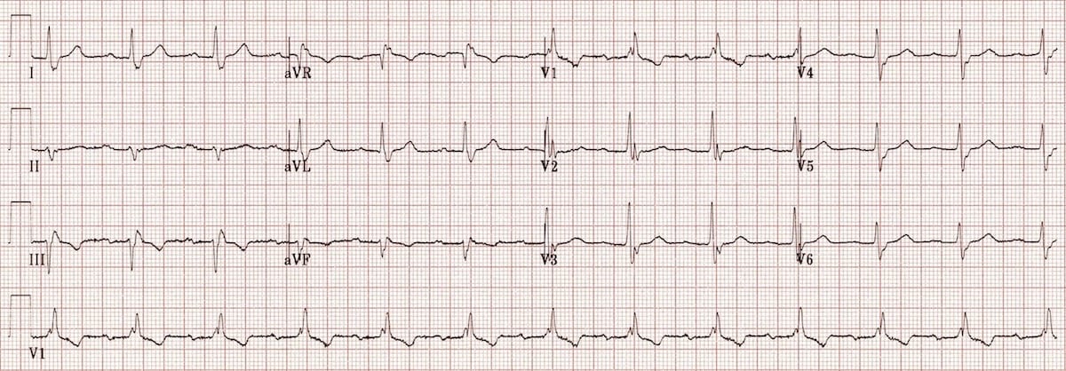 trifascicular-block 2