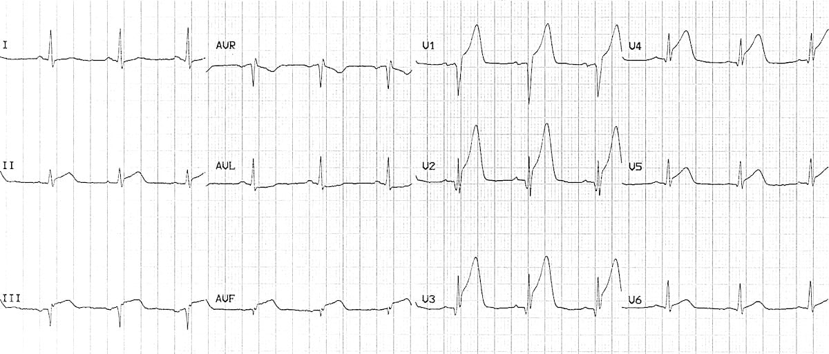 ECG Anterior-inferior STEMI