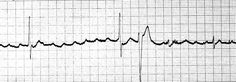 ECG Digoxin toxicity PAT