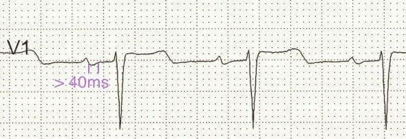 P wave terminal portion