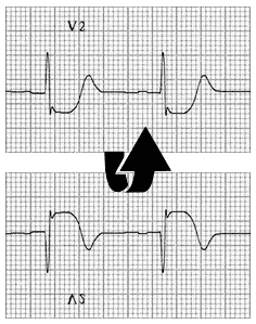 Posterior AMI flip STEMI ST Elevation