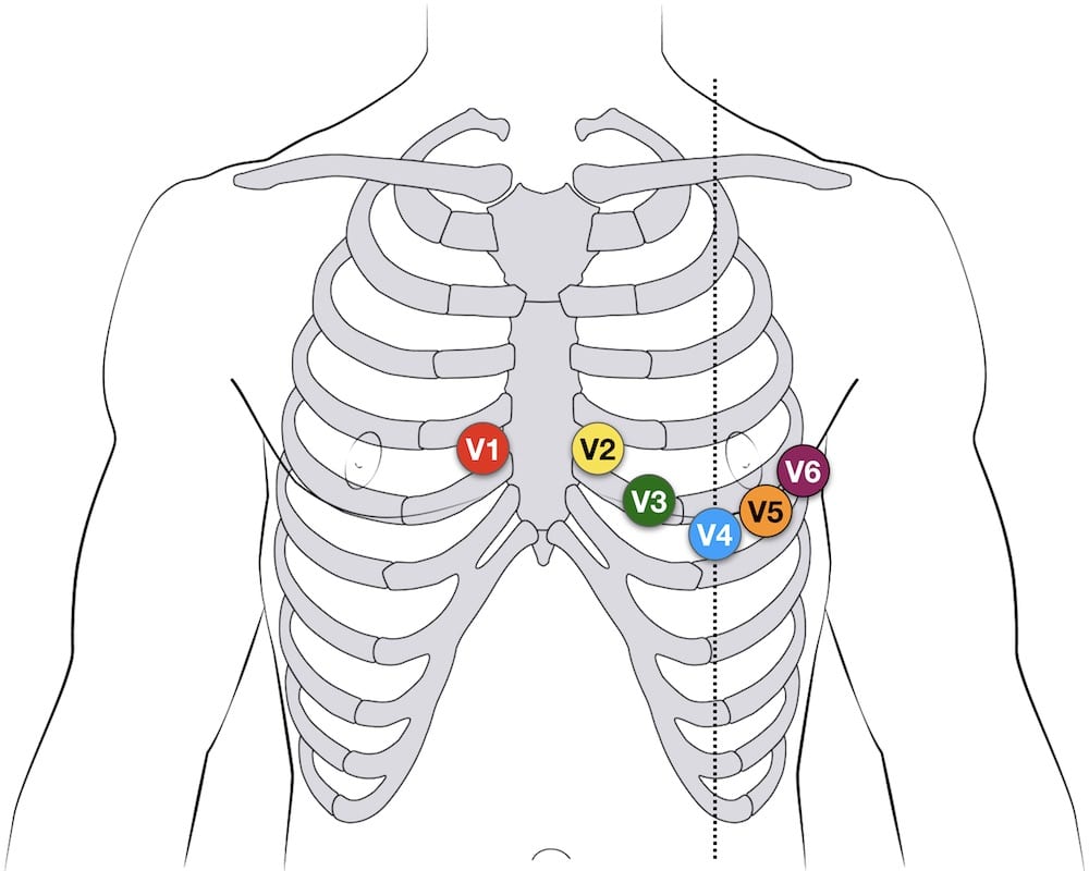 12 lead ECG EKG lead placement