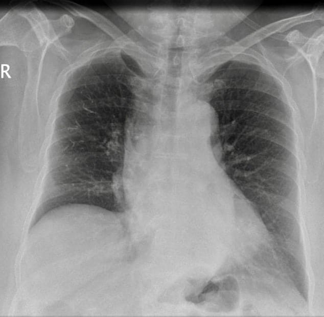 Cement embolus CXR OA