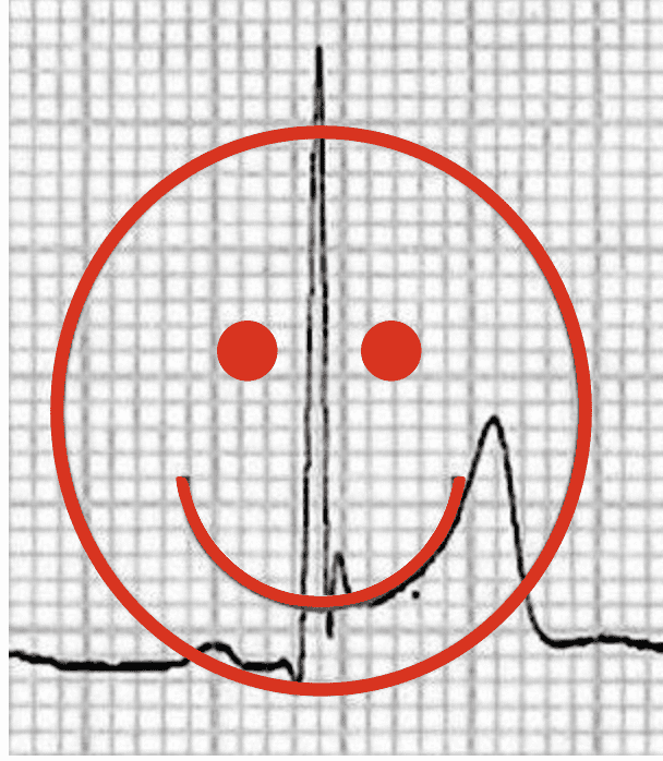BER ST-elevation Smiley-face