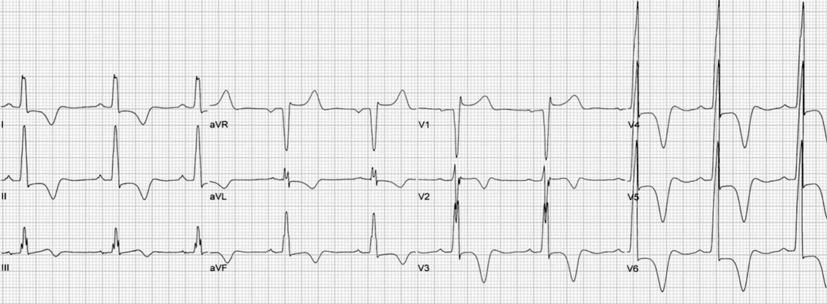 ECG HCM Apical