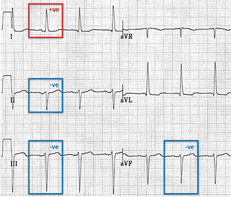 Left Anterior Fascicular Block (LAFB) Left axis LAD
