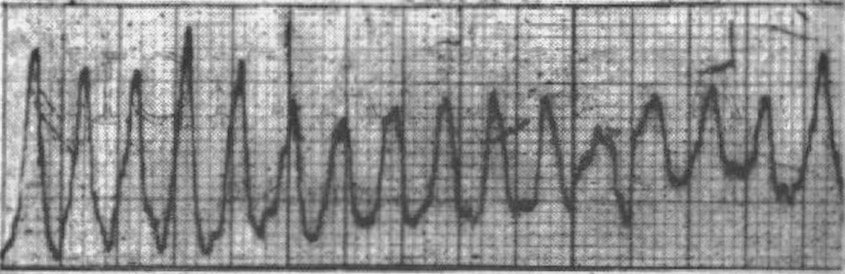 Romano-Ward syndrome TdP in patient BH 1964