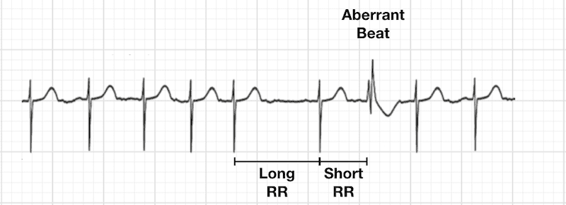 ECG Ashman Phenomenon 5