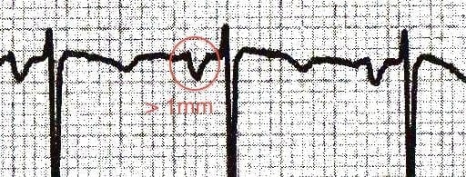 P waves with terminal portion more than 1mm deep in V1