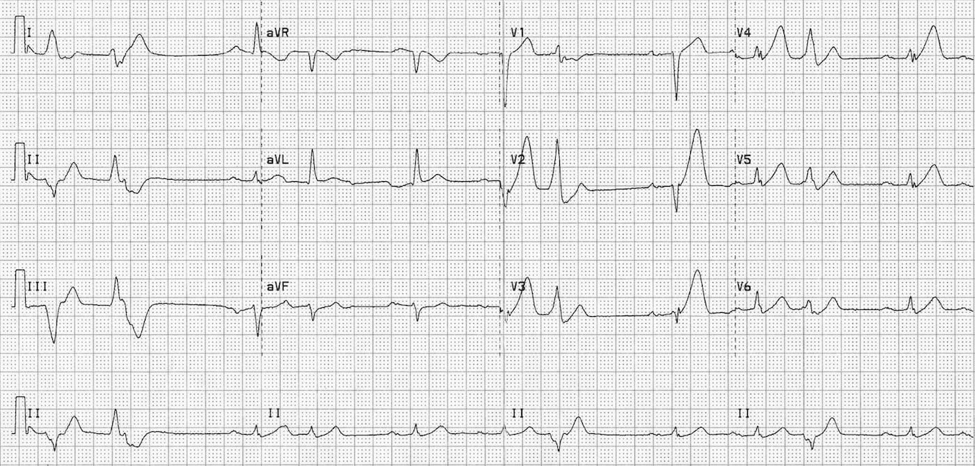 ECG Anterior STEMI hyperacute 2