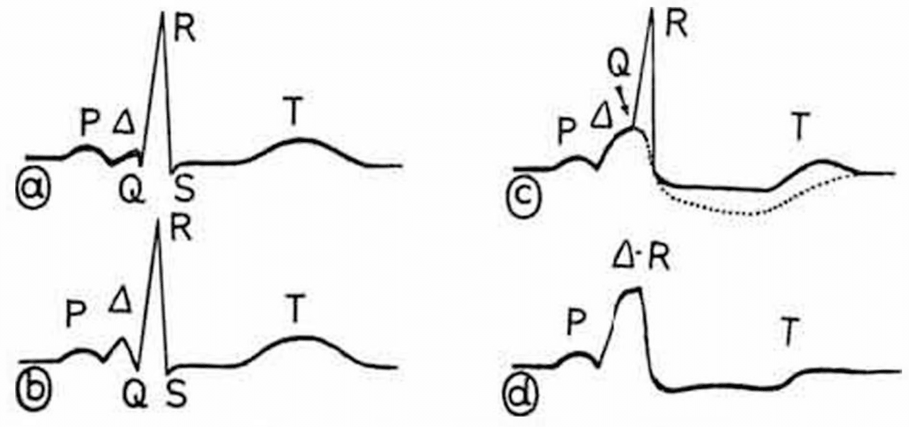 1944 Segers et al Delta wave origin