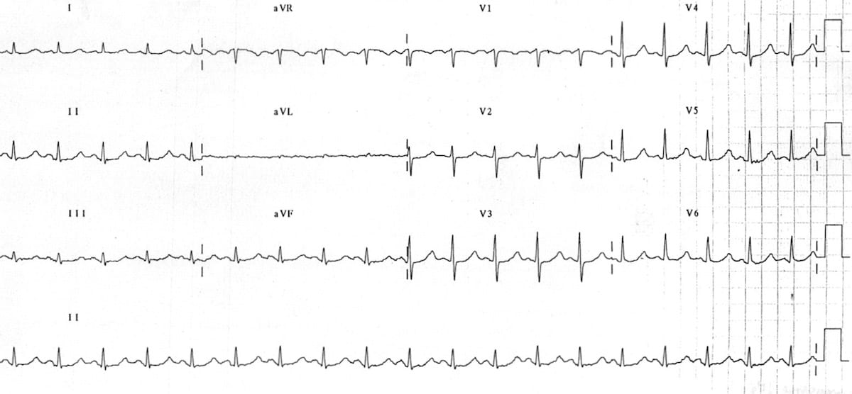 ECG Hypomagnesemia prolonged QT