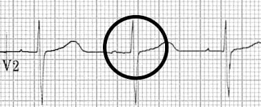 Retrograde P waves in V2 have resolved 2