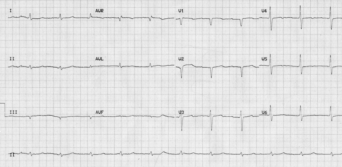 ECG hypothyroid myxoedema coma 2