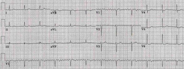 ECG Digoxin toxicity regularised AF
