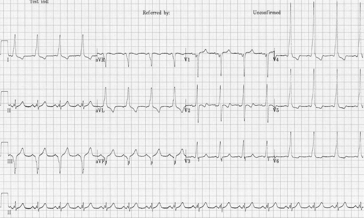 WPW Type B ECG 2