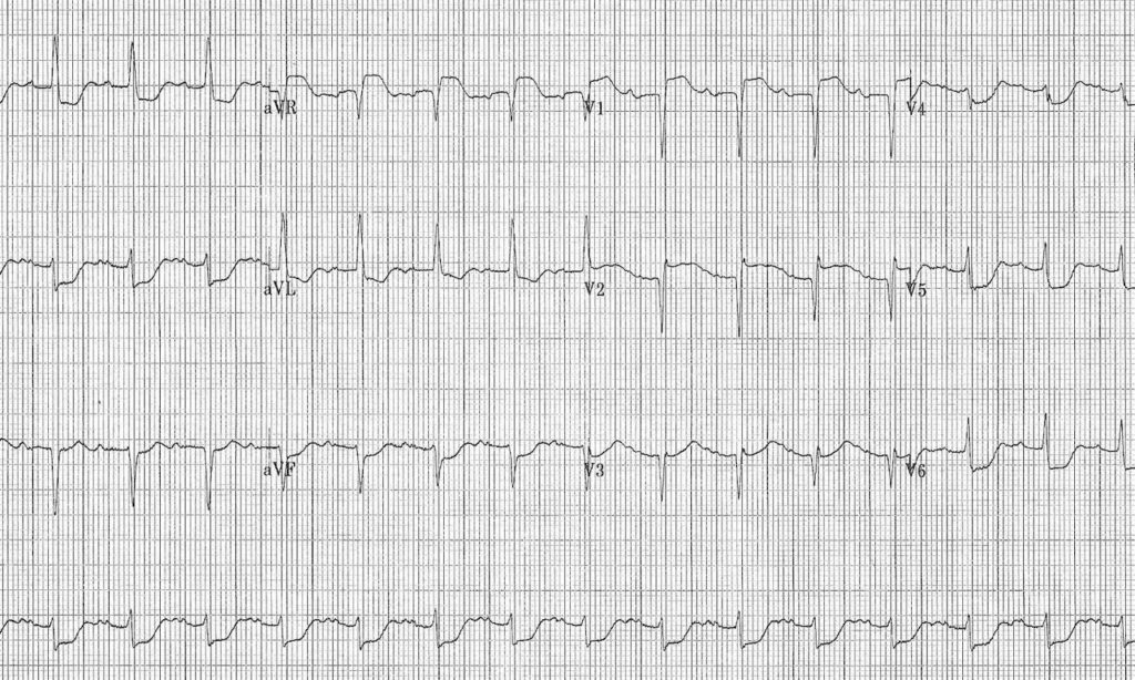 ECG 075a LITFL Top 100