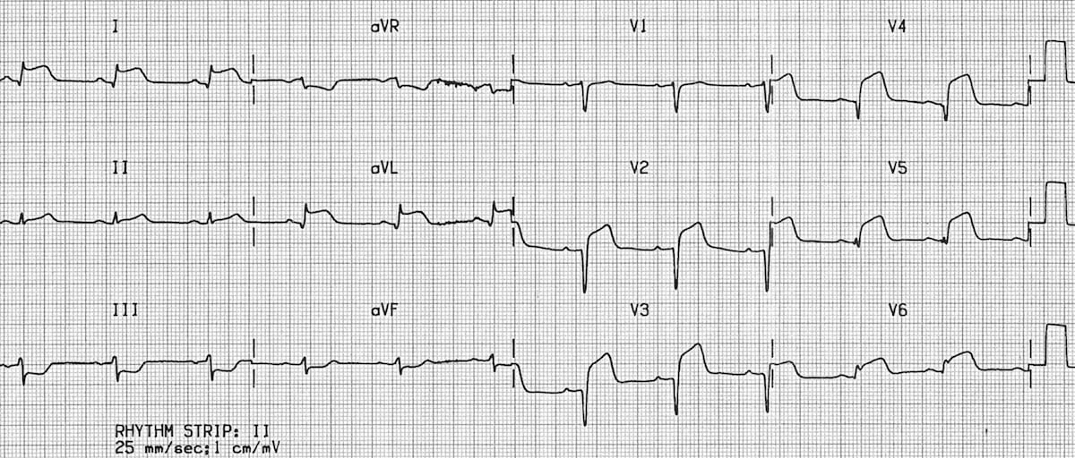 ECG Anterolateral STEMI 1