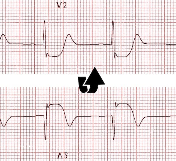 ECG Posterior AMI flip image V2