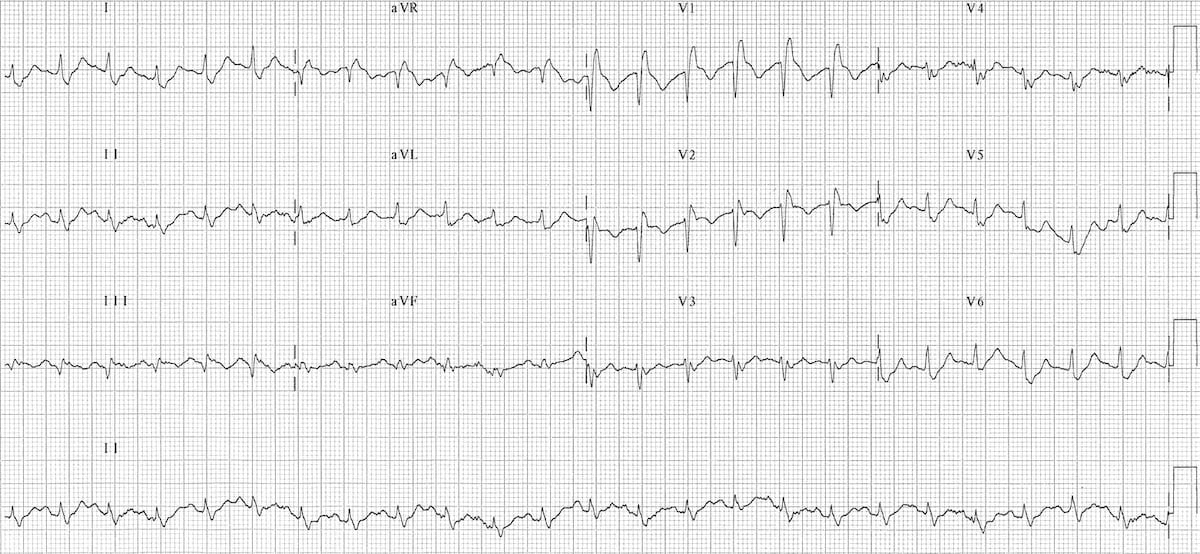 ECG Massive bilateral pulmonary embolus