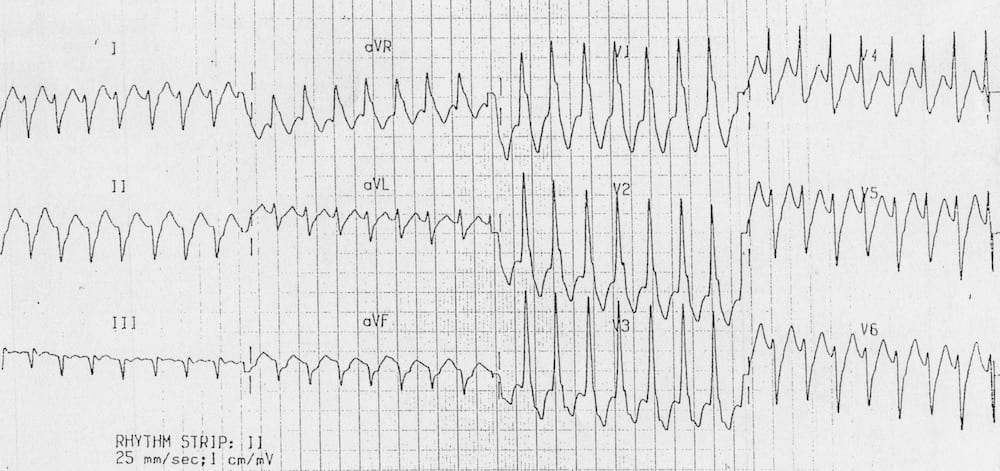 TOP 100 ECG QUIZ LITFL 013