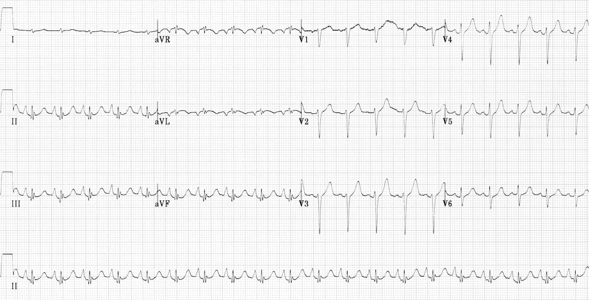 Pulmonary disease pattern COPD ECG 2