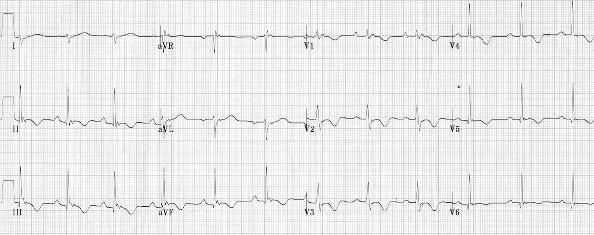 ECG ARVD ARVC RVH