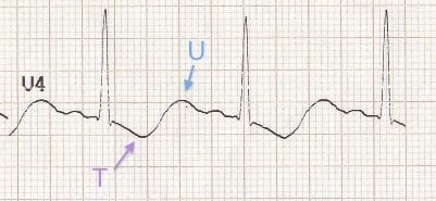 U waves ECG hypokalemia